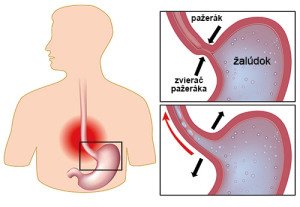 gastroezofagealny-reflux
